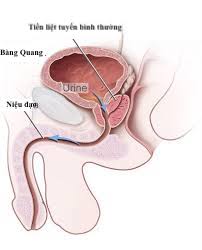 Hẹp niệu đạo